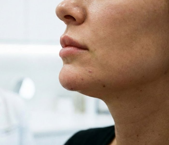 Chin Tip Botox