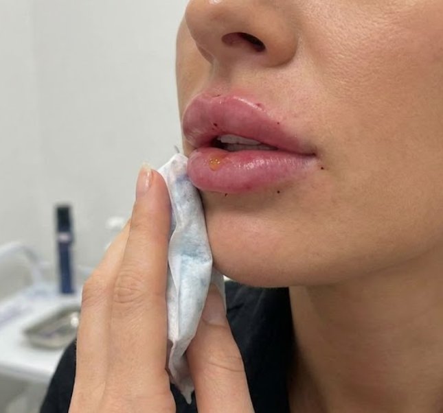 Lip Filler