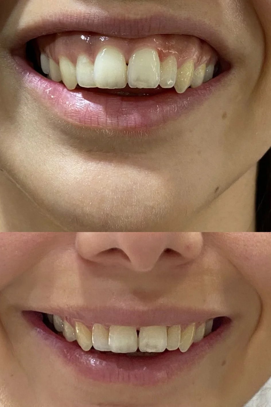 Gummy Smile Botoksu (Diş Eti Gülüşü)