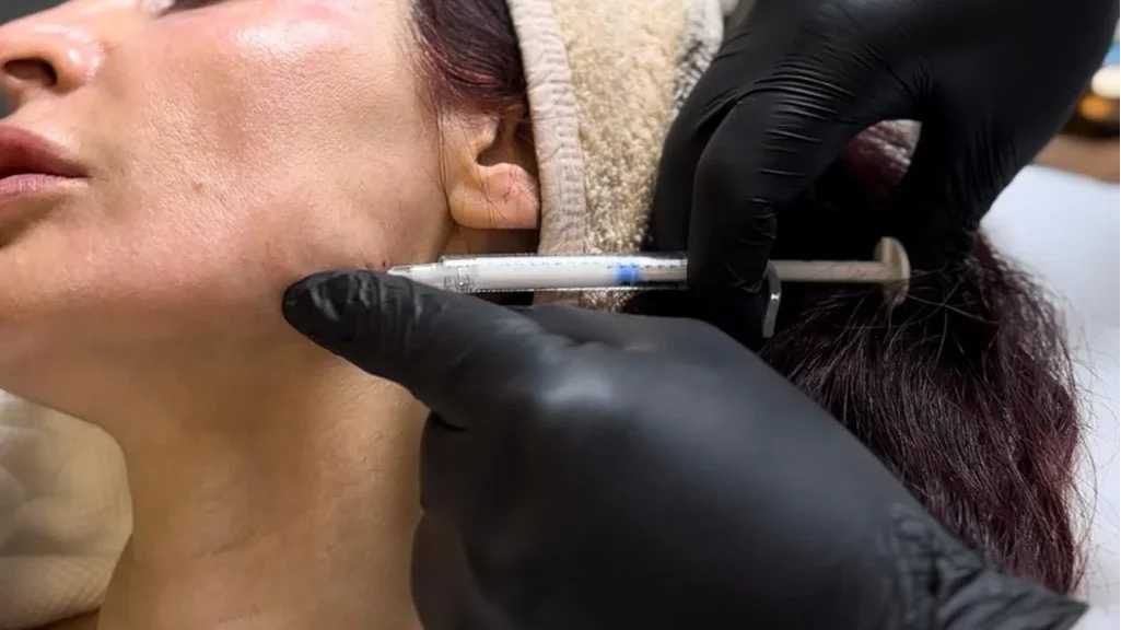 Jawline (Çene Hattı) Dolgusu