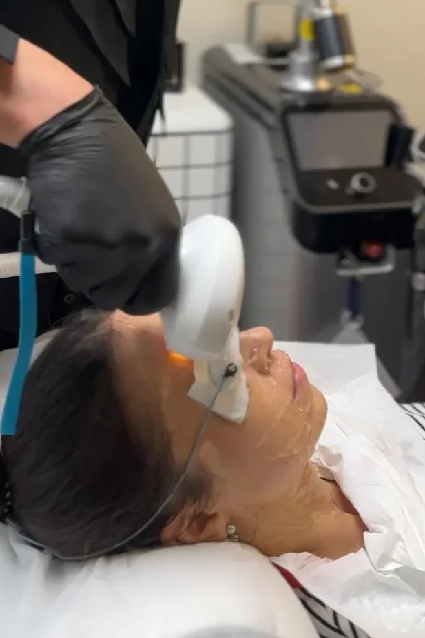 Lumecca (IPL – yoğunlaştırılmış ışık)