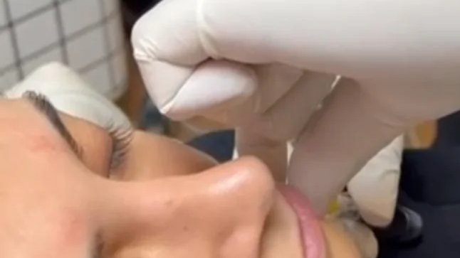 Marionet Dolgu Uygulaması